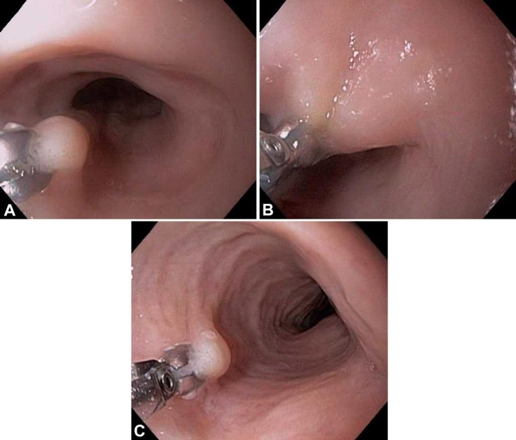 ENDOSZKÓPOS KÉP Nyálkahártya megvastagodás Pontozottság/eosinophil exsudatum/microabscessusok Koncentrikus körök Hosszirányú barázdák