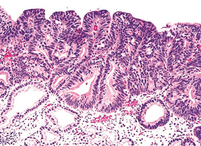 Barrett oesophagus high grade dysplasiával (nem