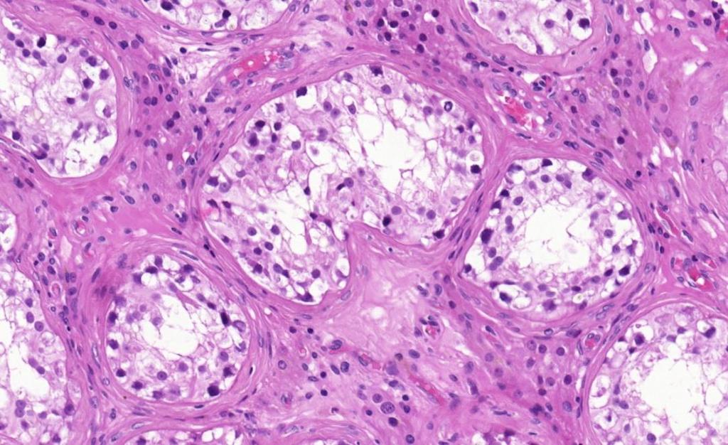 3. ábra. GCNIS hematoxilin-eozin (HE) (A) és PLAP (B) immunhisztokémiai metszete.