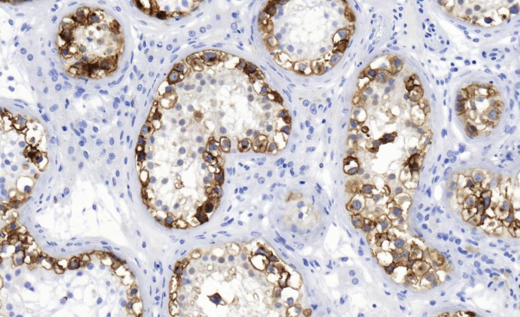 5.1. Egyéb intratubularis neoplazmák Az egyéb intratubularis neoplazmák jelentősége kevésbé világos, mint a GCNIS-é.