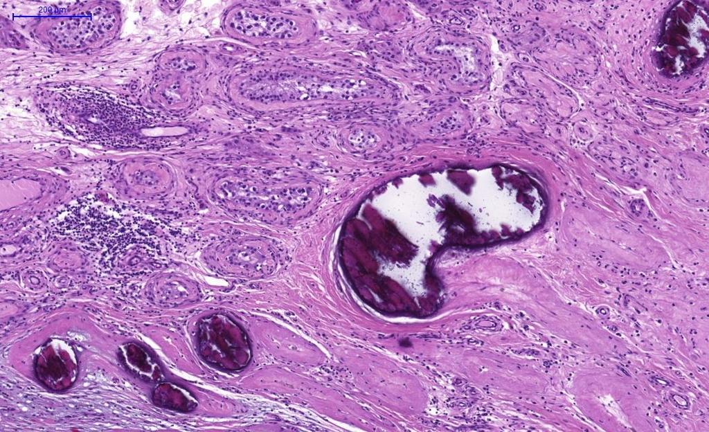 nekrózissal és kalcifikációval is együtt járhat, ami tumor regresszió részjelenségének is tekinthető (4. ábra) (110-113).