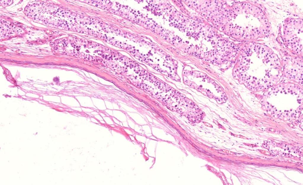 7B. ábra. Epidermoid cysta felnőttkori benignus teratomában. A széli részen megtartott szerkezetű herecsatornácskák mutatkoznak, GCNIS nem azonosítható. 1.8.