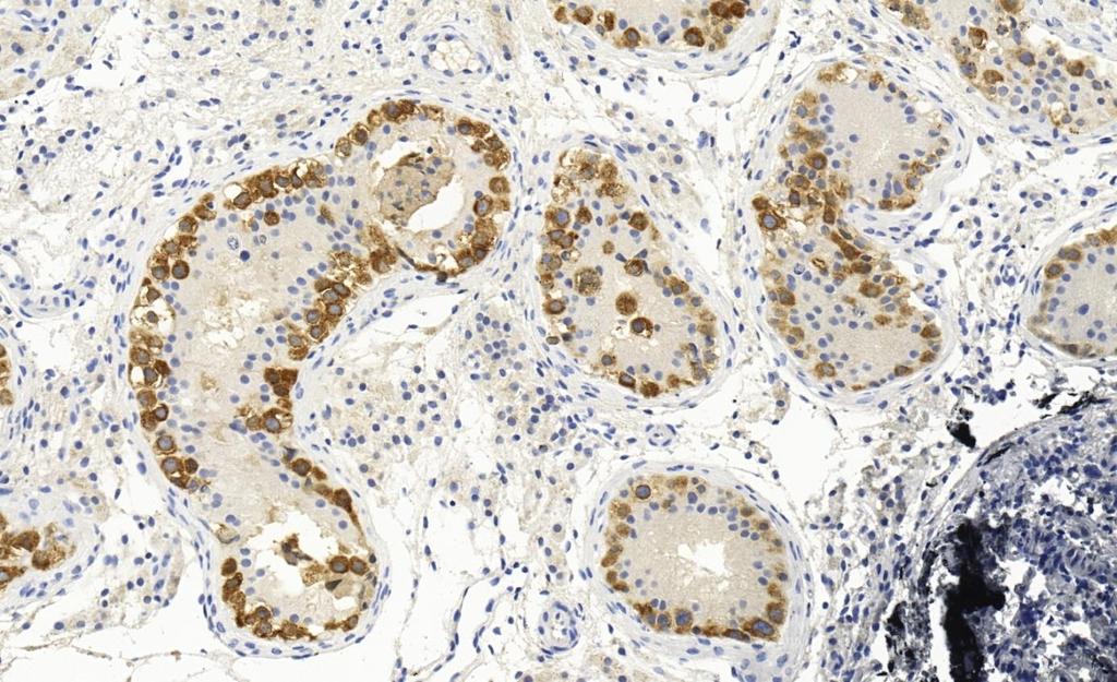 IMP3 immunhisztokémiai vizsgálat az előző malignus esetből.