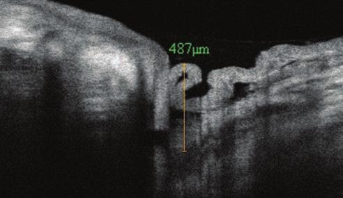 Imaging Lid-Parallel Conjunctival Folds with OCT and Comparing Its Grading 2.