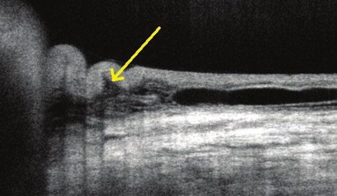 könnyfilm-lipidréteget takarnak. Statisztikai elemzés A statisztikai elemzés és az ábrák kereskedelmi forgalomban kapható szoftverrel készültek (SPSS 16.0; SPSS, Chicago, IL, és Statistica 8.