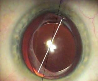 Toricus műlencsékkel szerzett tapasztalatok érzéstelenítésben, coaxialis torziós phacotechnikával, 2,8 mm-es, temporálisan készített clear cor - neális főseben keresztül.