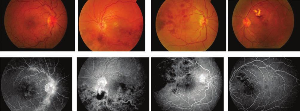 Retinal vein occlusion A KÓRKÉP JELENTŐ- SÉGE, EPIDEMIOLÓGIA A vénás keringészavar a diabéteszes retinopathia után a második leggyakoribb oka a vaszkuláris eredetű súlyos látáskárosodásnak (79, 94).