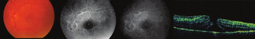 Retinal vein occlusion sus kereszteződésben az artéria az esetek nagyobb hányadában a vé - na felett (az üvegtesti térhez közelebb) fut.