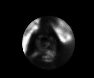 Probing with irrigation at the age of 3 had failed. She had dilated inferior lacrimal puncta with excess tearing. There was no sign of acute inflammation.