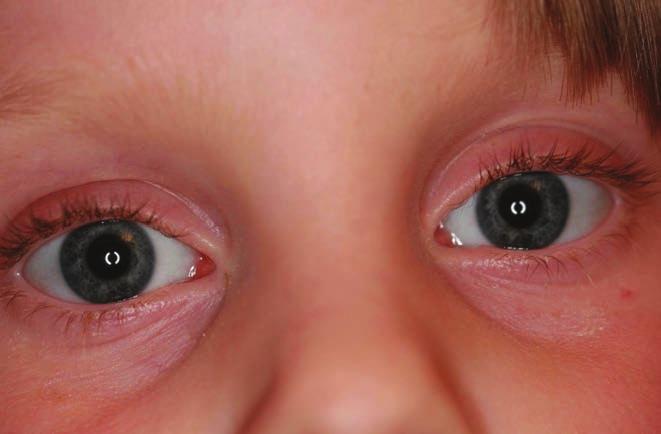Endocanalicular en - dos copy was performed under general anesthesia.