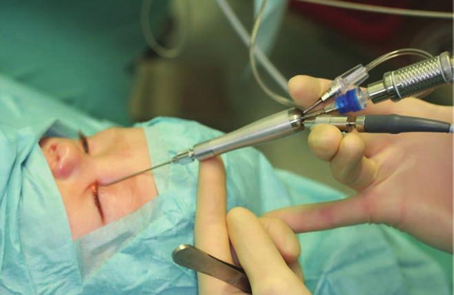Pediatric endoscopical dacryoplasty with a microdrill FIG. 4. THREE CHANNEL ENDOSCOPE OF 1100 μm (VITROPTIK T, POLYDIAGNOST; PFAFFENHOFEN, GER - MANY) more flexible.