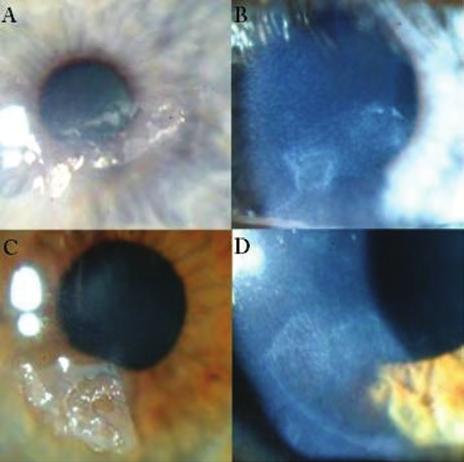 Management of the complications of the alkali burn 1. ábra: L.J. szeméről PTK-kezelés előtt (A) és a behámosodást követően (B), P.S.