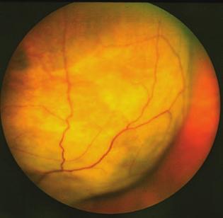 Uveal melanoma 1. ábra: A szem nagy ré szét kitöltő endo - phyticus chorioidea me - lanoma (szövettani diagnózis, enucleatio történt) velve ezzel az áttétképződés kockázatát (1, 5, 9, 15, 21).
