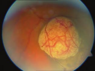 Az uvea melanomák 2. ábra: Amelanotikus melanoma jellegzetes képe (FNAB megerősítette a klinikai diagnózist, brachytherapia tör - tént) mentált változatok (2. ábra) ame - lanotikus melanoma ritkábbak.