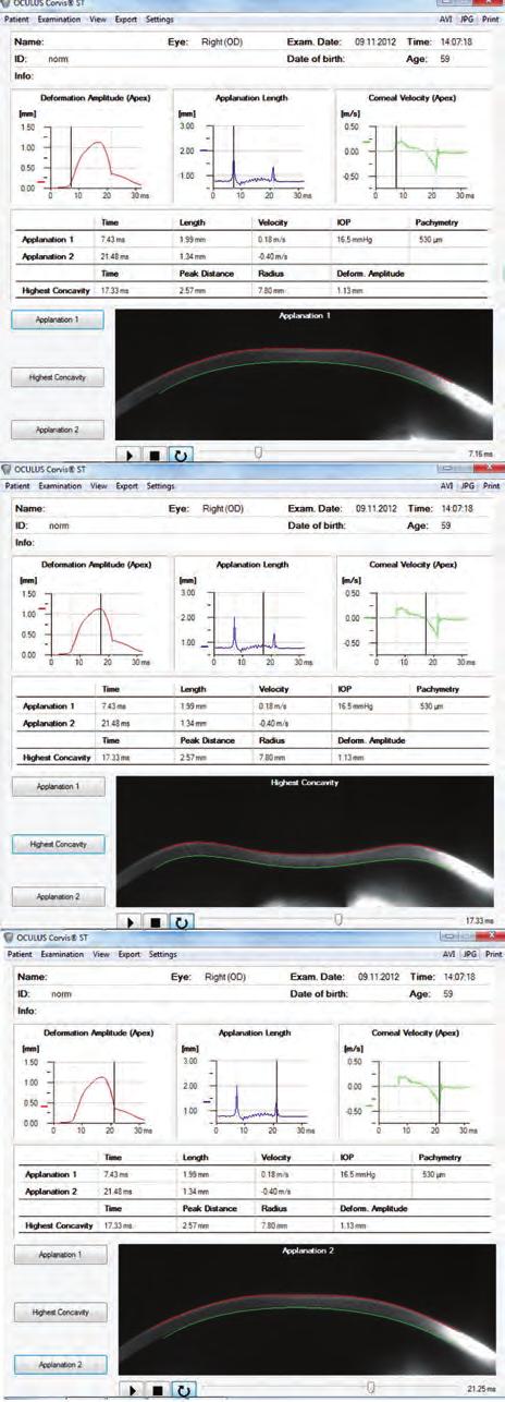 Examination of biomechanics of normal corneas with Scheimpflug-based imaging Aszem elülső szegmentum paramétereinek pontos és megbízható mérése a szemészeti műtétek tervezéséhez és az utánkövetéshez
