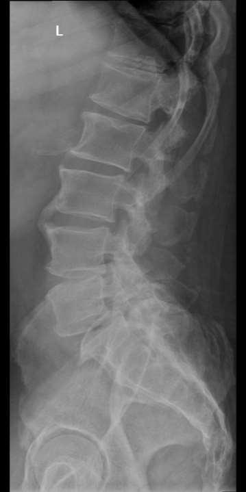 Spondylolysis, -listhesis instabilitással járó