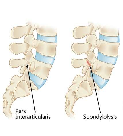 Spondylolysis Egyoldali csigolyaív szakadás (leggyakrabban az L4, L5 ágyéki csigolya