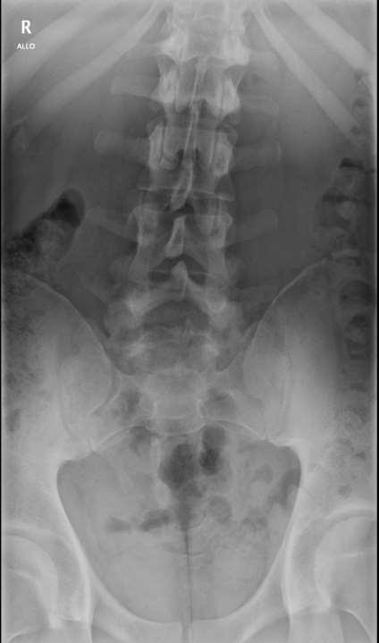 Spina bifida A csigolyaív záródási, fejlődési rendellenessége. Gyakori fejlődési rendellenesség, többnyire az L5 és S1 csigolyákat érinti.