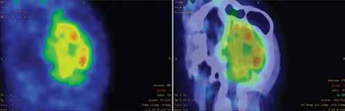 KISÁLLAT EPENDYMOMA ÉS SZERZETT MÁJELÉGTELENSÉG ROHAMTÜNETEK Halántéklebenyi (temporális) eredetű elemi és komplex parciális rohamok: orális automatizmusok (csámcsogás nyálzással vagy anélkül,