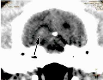 lehetett kimutatni az alapvetően kis agykérgi perfúzió mellett, az agytörzsi területeken (a thalamus és az orbitofrontalis terület környékén) pedig a megszokottnál kisebb vérátfolyás jelei