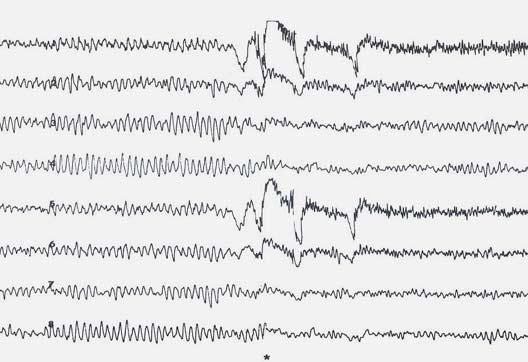 3.3. Elektrofiziológiai módszerek 3.3.1. Elektroenkefalográfia Az agy elektromos tevékenységének vizsgálata az elektroenkefalográfia.