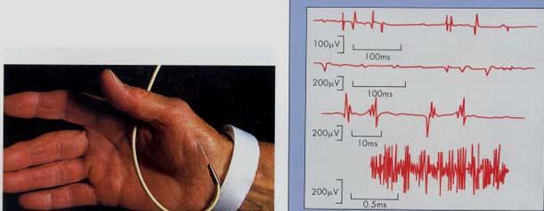 3.3.2. Magnetoenkefalográfia (MEG) A módszer az agyi elektromosság (töltésmozgások) által keltett mágneses erőtérváltozás (fluxus) elemzésén alapszik.