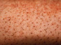 retinoid receptorok auto- és parakrin hatások epidermisz védelme (bőrkrémek, akne kezelése)
