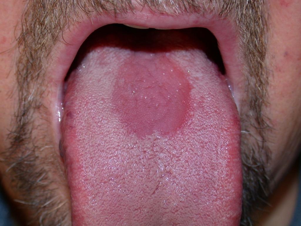 korlátozott pelle agra (durva bőr, dermatitis), fekete nyelv (glossitis) 3D:
