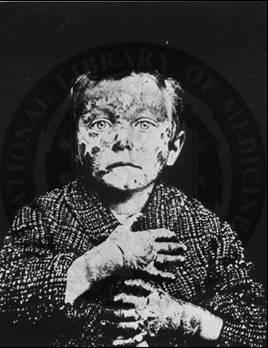 amino-transzferázok Hiány: emberben nagyon ritka dermatitis,