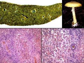 Gombamérgezés Amanita phalloides Kiterjedt necrosis