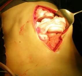 tamponade
