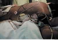 Premise of prone position ventilation Recruitment of collapsed alveolar units Reduction in V/Q heterogeneity with improved ventilation and reduction of shunting