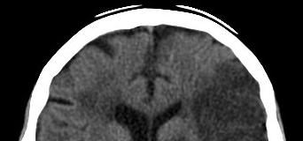 American Journal of Roentgenology High incidences of PEs and other