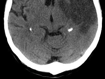 Experience Consistent with research Several incidences of PEs, DVTs, and a fatal