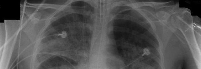 Acute onset No Hx of chronic lung Dz