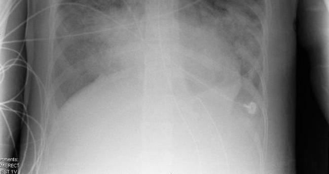 elevated Lt atrial pressure PCWP: < 18