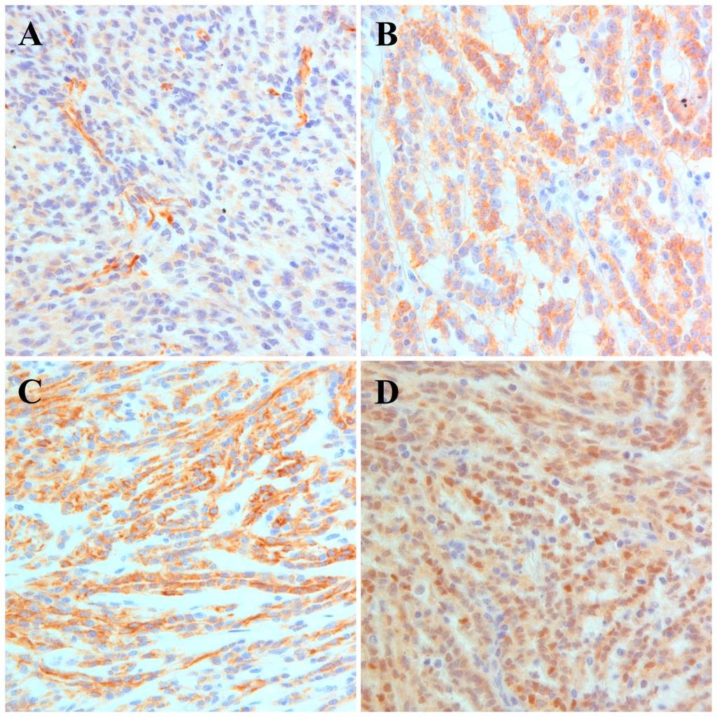 13. Ábra. MTSCC immunhisztológia. A. Nincs immun-reakció WT1 antitesttel az MTSCC sejtmagjaiban. B. Közepes intenzitású pozitivitás az AMACR antitesttel. C.