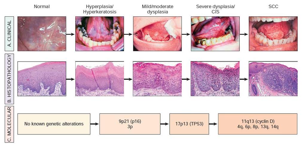 A szájüregi rák klinikai, hisztológiai és molekuláris progressziója A: a szájüregi rák idealizált klinikai progressziója.