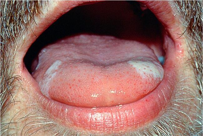 Oral hairy leukoplakia Oral hairy leukoplakia (OHL, vagy HIV-asszociált hairy leukoplakia) egy