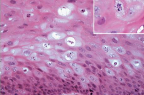 gyakoribb Keratoacanthoma: nagy szarukráter, epithel proliferatio széles kötegekben, lehetnek invasiv leszakadó szigetek, differenciál diagnózis: