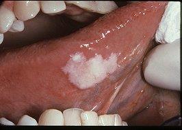 Leukoplakia differenciál diagnosztikája, fogalma Lapos, fehér folt/plakk, le nem törölhető, dohányosokban