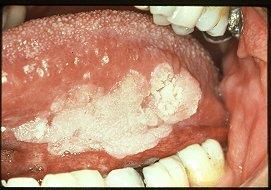 Hátterében állhat hám hyperplasia, elszarusodó laphám metaplasia, dysplasia/ in situ carcinoma, invasiv