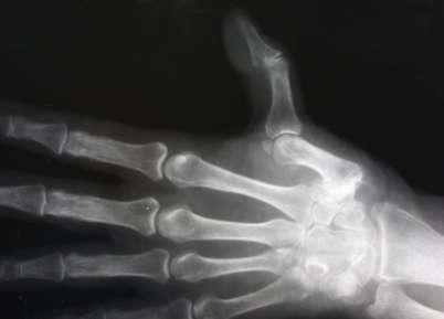 röntgen terápia az artrózis kezelésében ízületi fájdalom a vállízületet sújtja