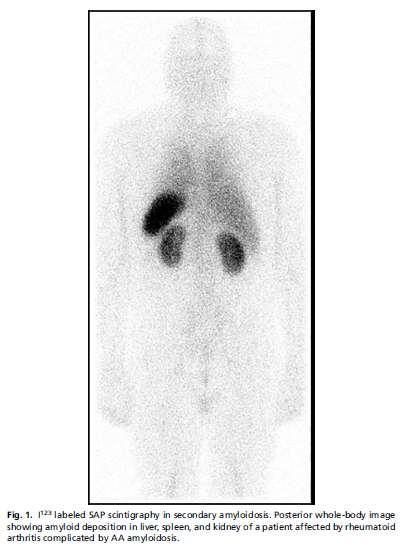 Képalkotó diagnosztika SAP szintigráfia 90% szenzitivitás Kis sugárterhelés Alkalmas az érintettség meghatározására és a nyomon követésre Nem jelzi a lerakódott amyloid mennyiséget és a