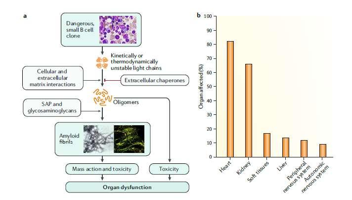 Szisztémás AL amyloidosis Merlini G, Dispenzieri A, Sanchorawala V, Schönland SO, Palladini G, Hawkins