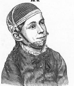KÉSZÜLÉKEK Occipitális húzás (1879) "For the lower part, I made a brass plate to fit the chin, having arms with hooked ends reaching to a point just below the point of the chin.