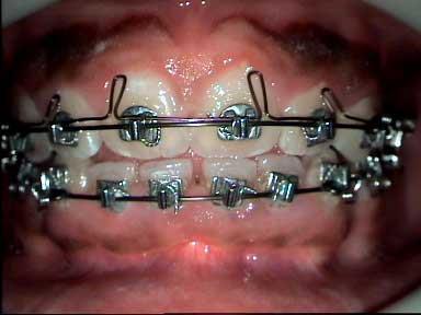 Begg-technika (Light-wire Differential Force