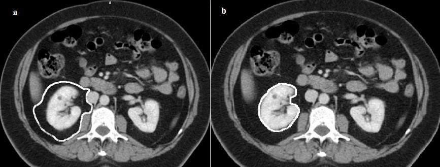 the level of right superior iliac spin and from 1 cm proximally of aortoiliac bifurcation,