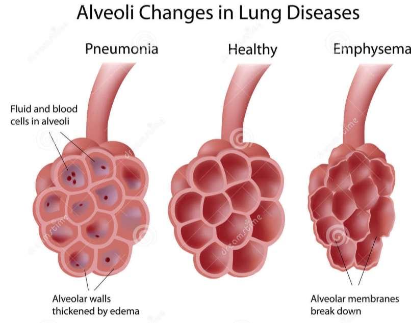 Változások az alveolusokban különböző tüdőbetegségek esetén tüdőgyulladás egészséges