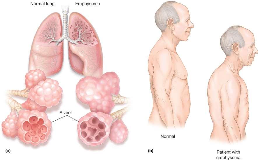 Tüdőtágulat Emphysema